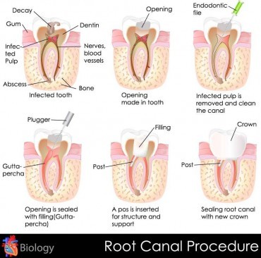 What Is Root Canal Treatment?