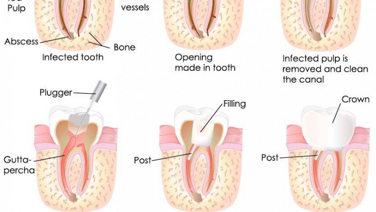 What Is Root Canal Treatment?