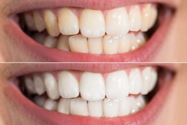 Teeth Whitening – Should I do it?