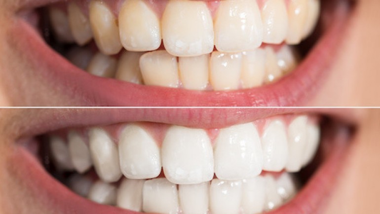 Teeth Whitening – Should I do it?