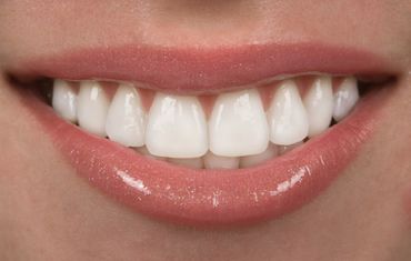 Frequently Asked Questions About Porcelain Veneers