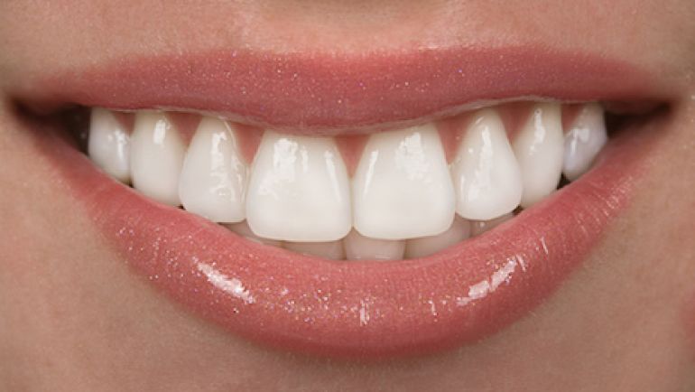Frequently Asked Questions About Porcelain Veneers