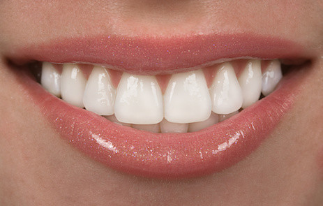 Frequently Asked Questions About Porcelain Veneers