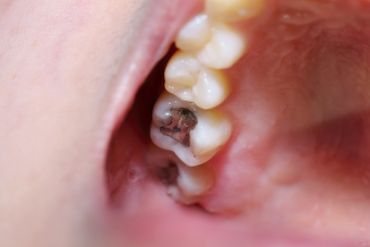 Why do dentists keep using amalgam fillings (‘silver fillings’)?