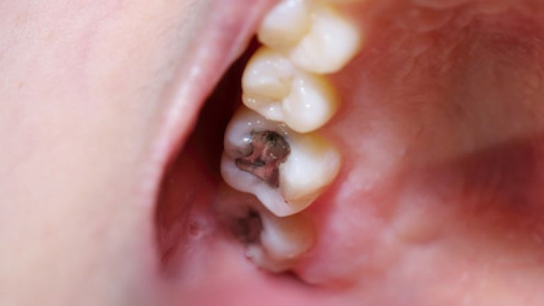 Why do dentists keep using amalgam fillings (‘silver fillings’)?