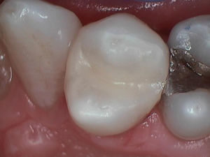 Tooth Decay Tooth Decay