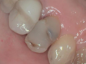 Broken Tooth Broken Tooth