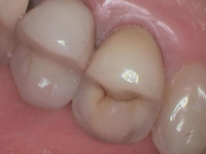 Cracked Tooth Cracked Tooth