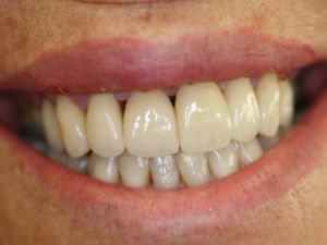 Tooth Aligner Tooth Aligner