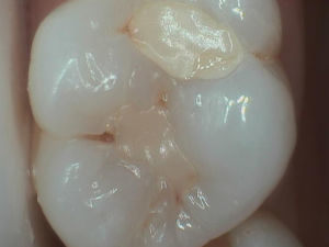 Tooth Filling Tooth Filling