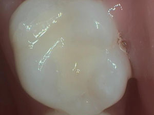 After Dental Treatment After Dental Treatment