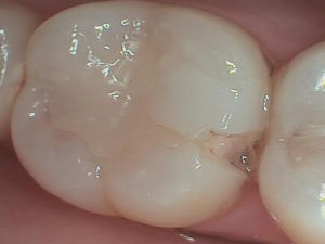 Dental Teeth Filling Dental Teeth Filling