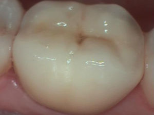 Tooth Restoration Tooth Restoration