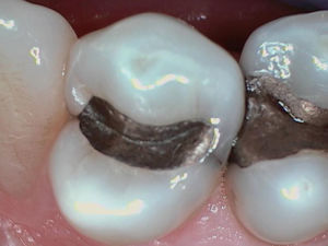 Before Tooth Decay Before Tooth Decay